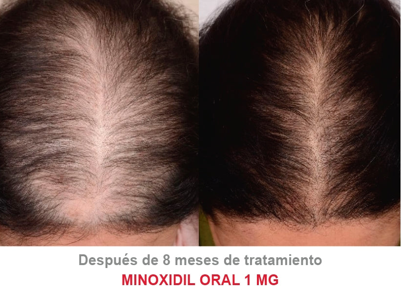 Minoxidil 1 mg con 30 tabletas para 1 mes de tratamiento