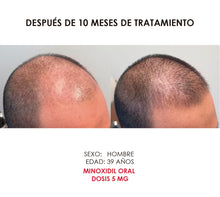 Minoxidil 5 mg con 30 tabletas para 1 mes de tratamiento