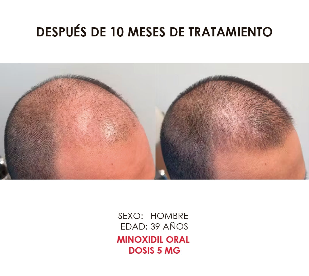 Minoxidil 5 mg con 60 tabletas para 2 meses de tratamiento